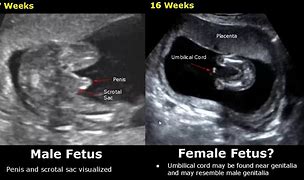 Image result for 15 Weeks Fetal