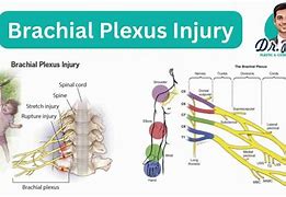 Image result for Brachial Plexus Injury