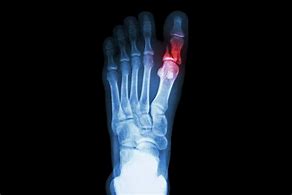 Image result for Broken Toe Bone