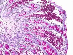 Image result for Whipple Specimen Gross Pathology