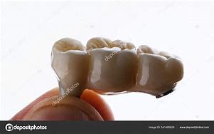 Image result for 3-Unit Bridge Front Teeth