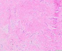 Image result for Cardiac Myxoma