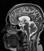 Image result for Toxic Leukoencephalopathy