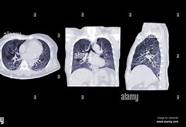 Image result for Coronal Lung CT