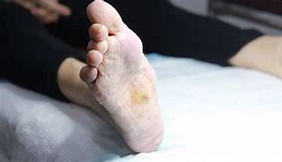 Image result for Charcot Bone Disease