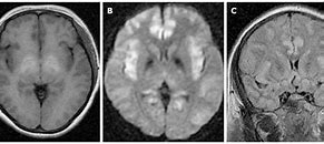 Image result for Hepatic Encephalopathy MRI