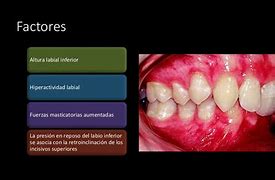 Image result for Tipos De Maloclusion