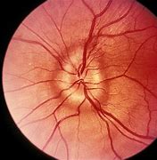 Image result for Enlarged Optic Nerve