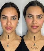 Image result for Chin Correction Filler