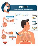 Image result for Peep COPD