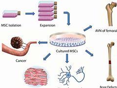 Image result for Avascular Necrosis Pathology