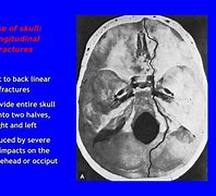 Image result for Skull Fracture