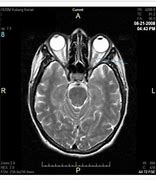 Image result for Enlarged Optic Nerve