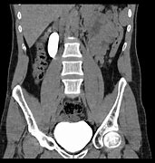 Image result for Retrocaval Surter Radiology