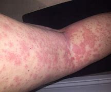 Image result for 10 Common Skin Rashes On Legs