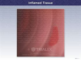 Image result for E Inflamed Tissue