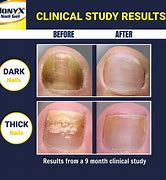 Image result for Keratin Debris Toenails