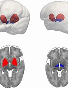 Image result for CT Brain Lentiform Nucleus