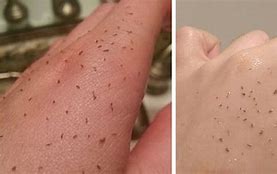 Image result for Skin Peels Blackhead Removal