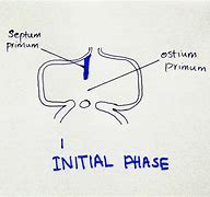 Image result for Interatrial Septum Formation