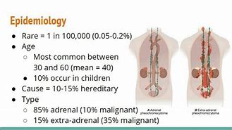 Image result for 5 Ps of Pheochromocytoma