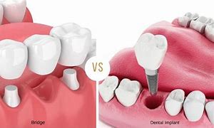 Image result for Dental Implant Bridge