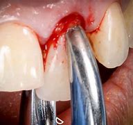 Image result for Alendronate and Tooth Extraction