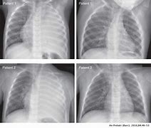 Image result for Pleural Infection