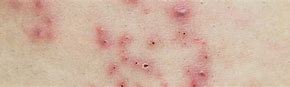 Image result for HIV Bumps On Fingers