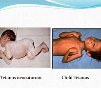 Image result for Tetanus Neonatorum