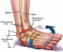 Image result for Lateral Malleolus Ligaments