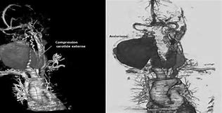 Image result for Angioscanner Des Troncs Supra Aortiques