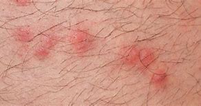 Image result for One Flea Bite