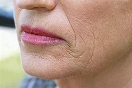 Image result for Atrophic Skin Aging