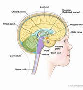 Image result for Medulloblastoma in Child