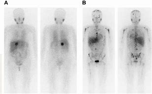 Image result for MIBG Pheochromocytoma