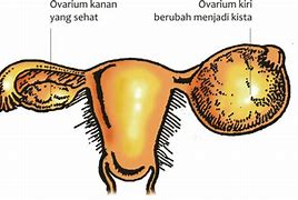 Image result for Kista Adalah