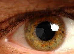 Image result for High Blood Pressure Eye Symptoms