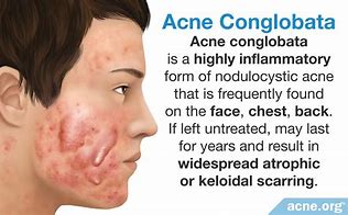 Image result for Severe Cystic Acne