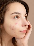 Image result for Pimple Face HD Images