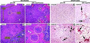 Image result for Necrosis Histology