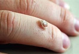 Image result for Filiform Wart On Finger