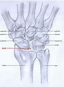 Image result for Triscaphe Joint Space Narrowing