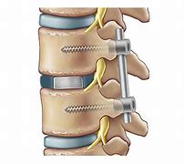 Image result for Lumbosacral Fusion