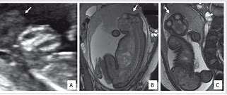 Image result for Anencephaly Ultrasound