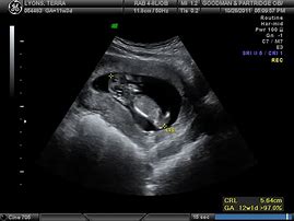 Image result for 14 Weeks and 4 Days Pregnant