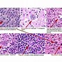 Image result for Lymphoma Panel