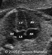 Image result for Right Atrial Appendage Fetal Echo