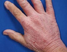 Image result for Eczema On Hands