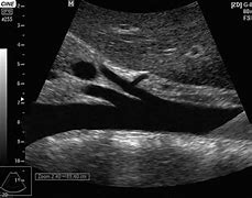 Image result for Abdominal Aorta Ultrasound